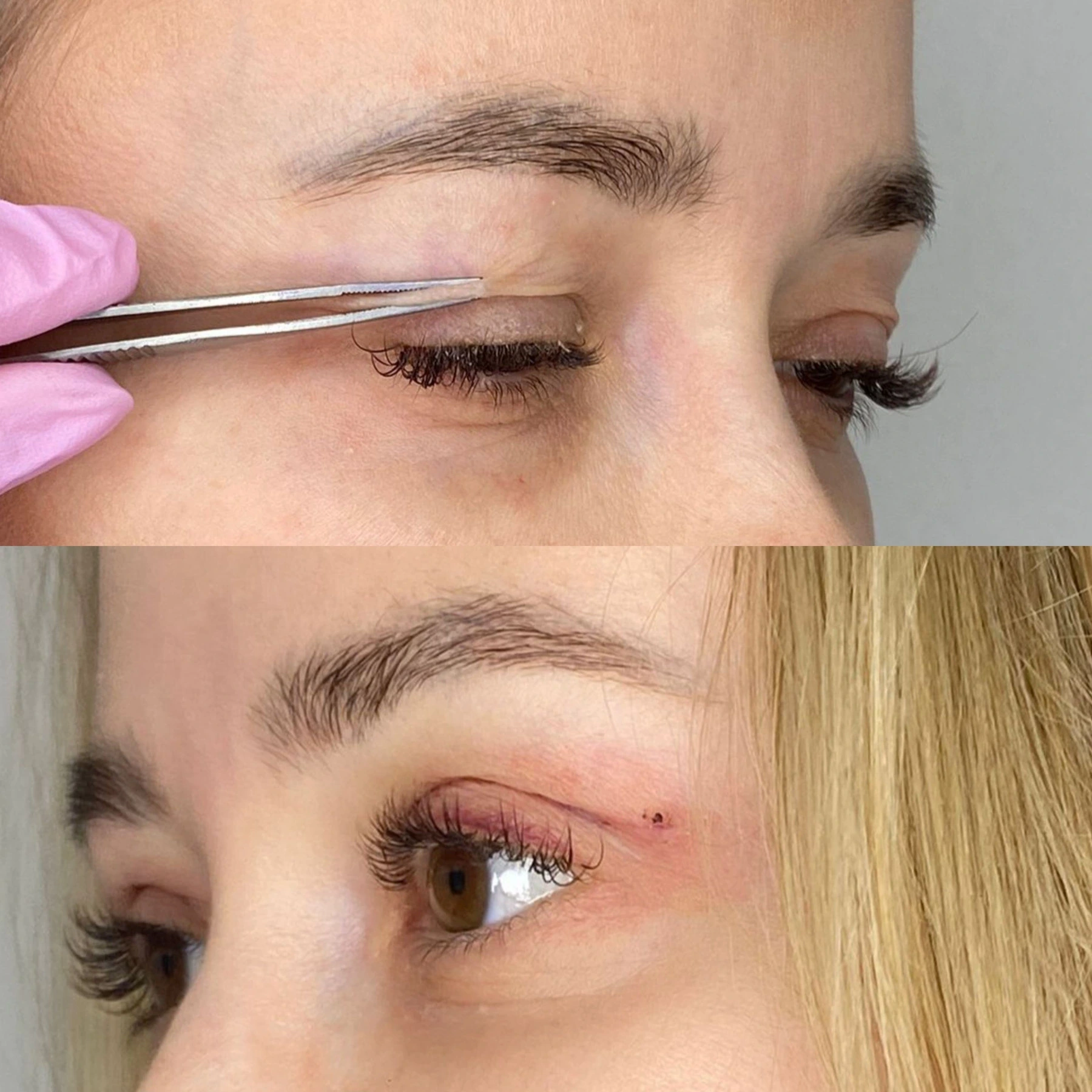 Operácia viečok – blefaroplastika