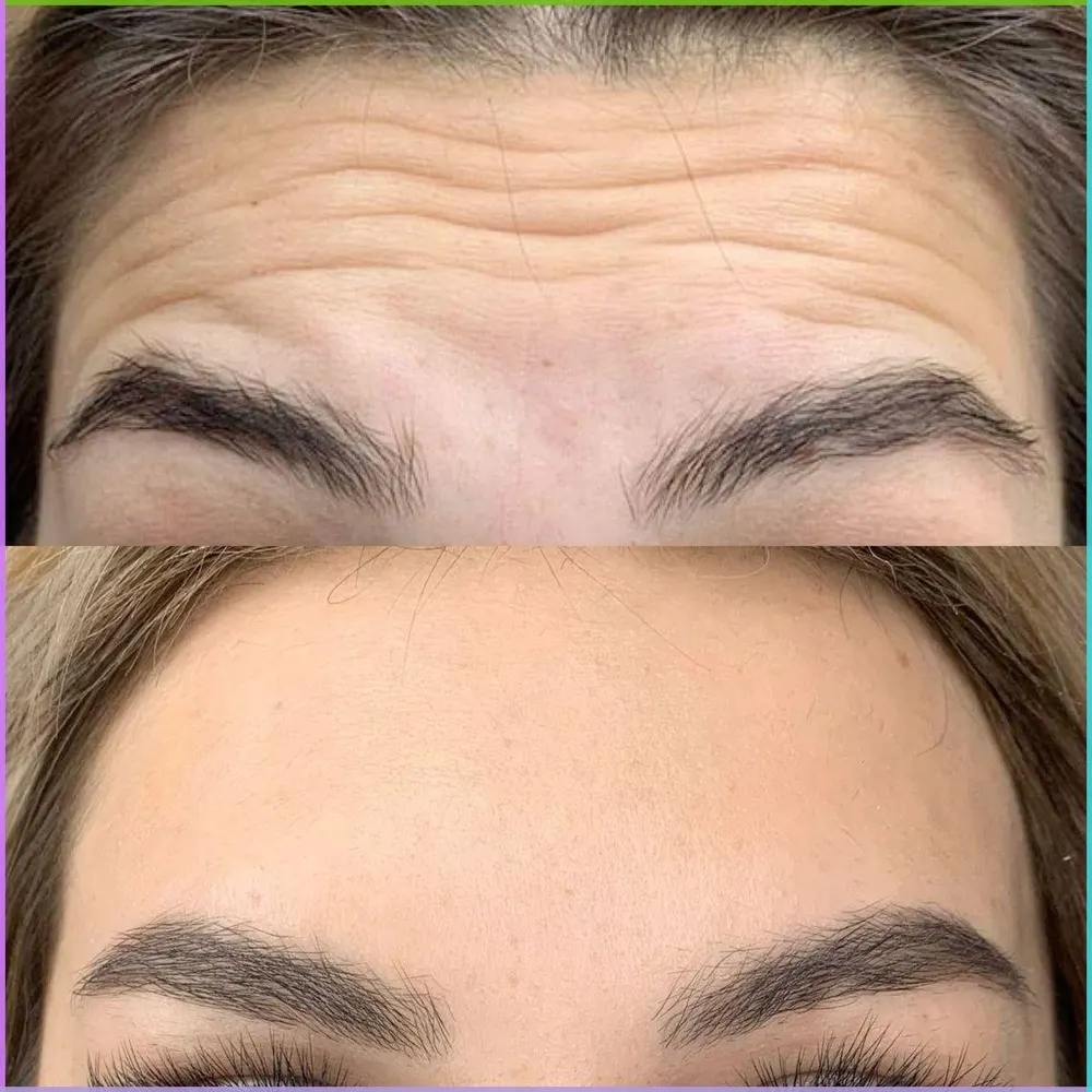 Botox