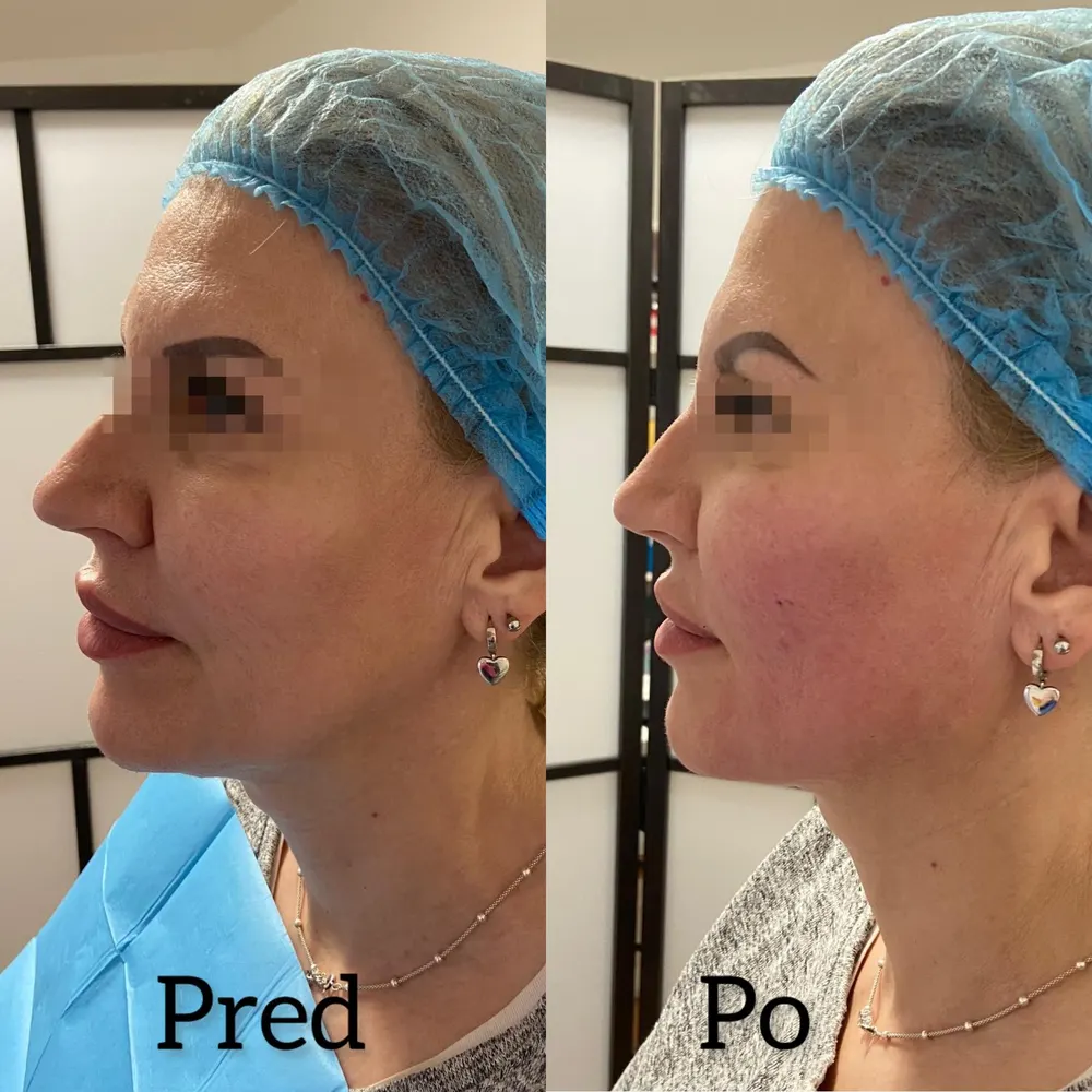 Endolift