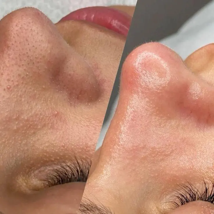 Hydrofacial