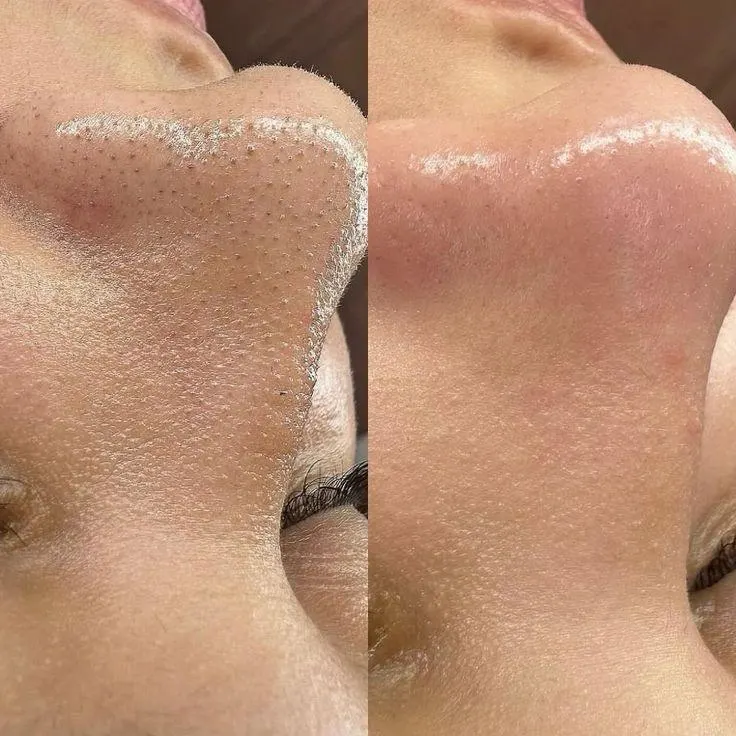 Hydrofacial2