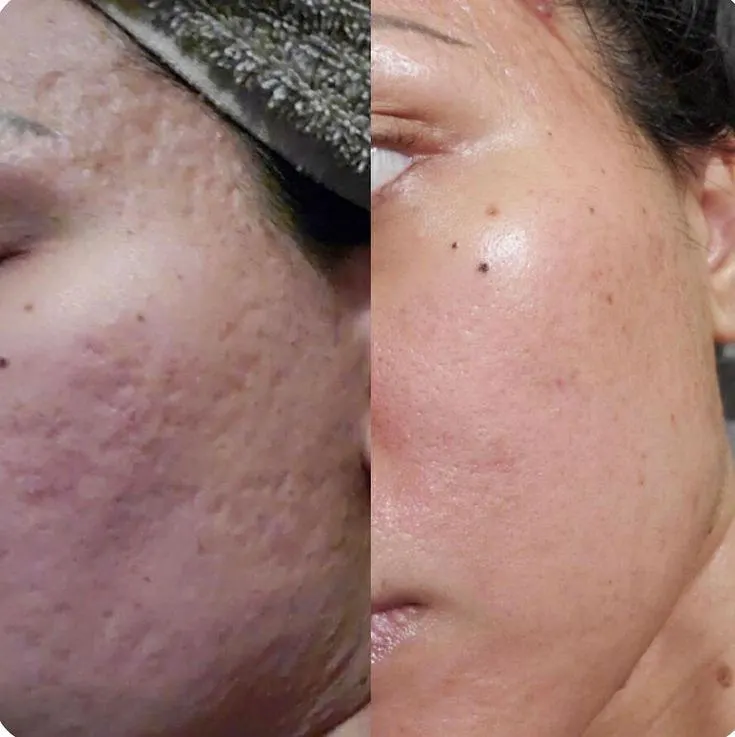 Pigmentacia co2resurf2