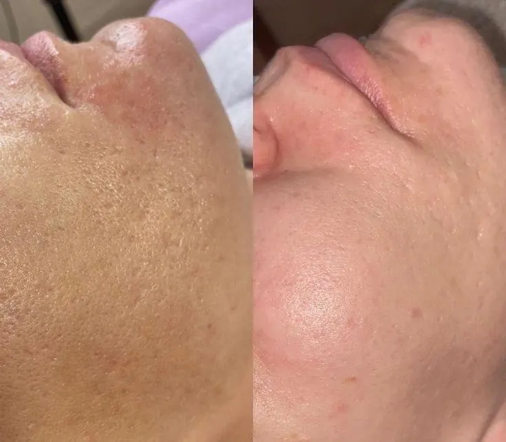 Pigmentacia co2resurfg
