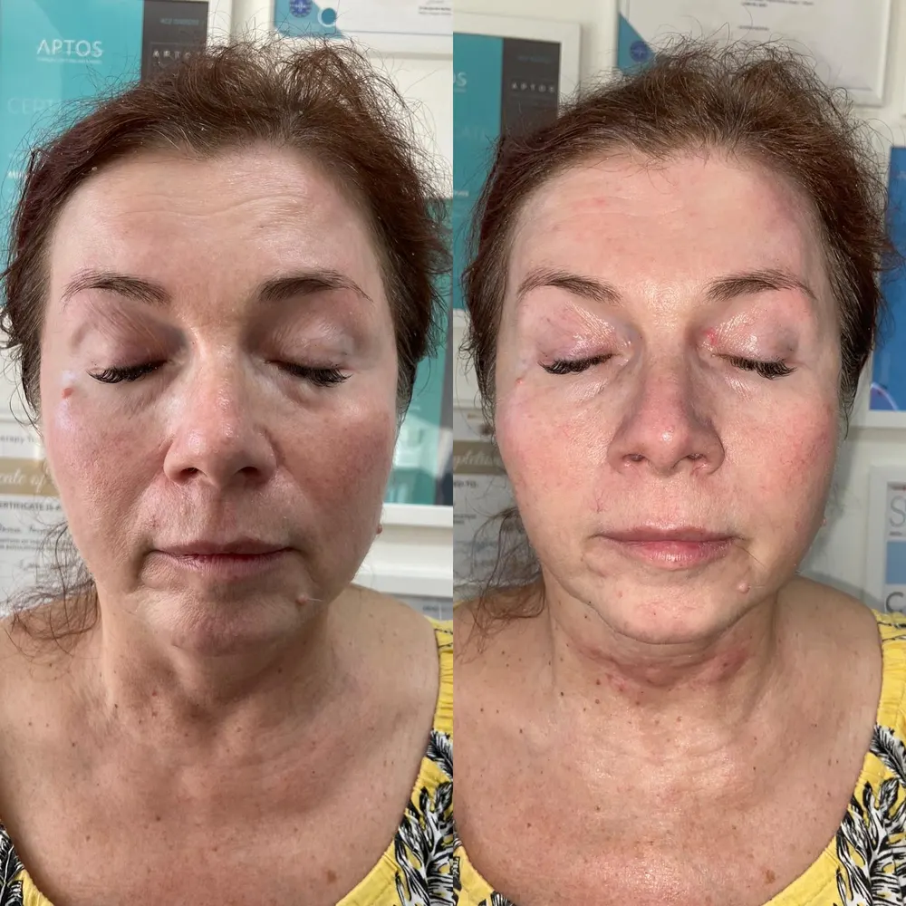 Skinbooster