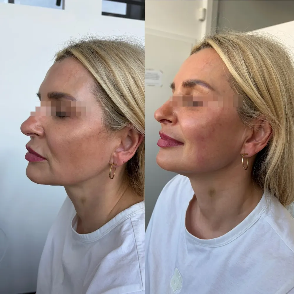 Ultherapy 4