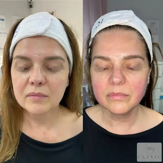 Ultherapy3