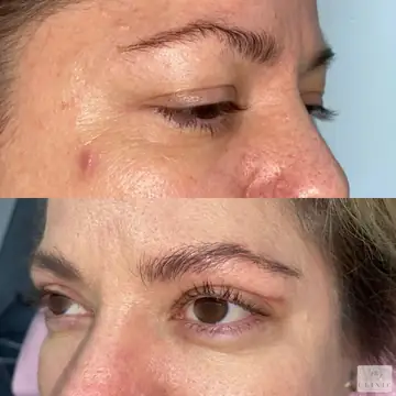 Operácia viečok – blefaroplastika – referencia 28