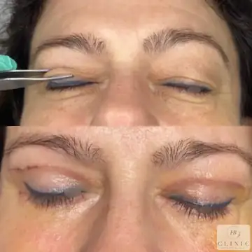 Operácia viečok – blefaroplastika – referencia 20