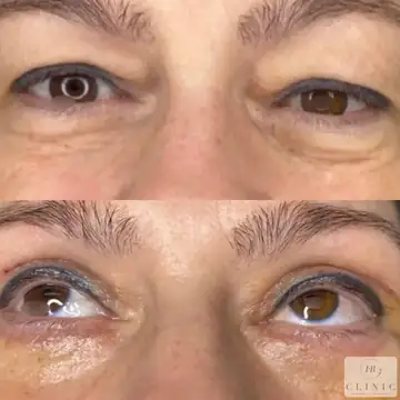 Operácia viečok – blefaroplastika – referencia 21