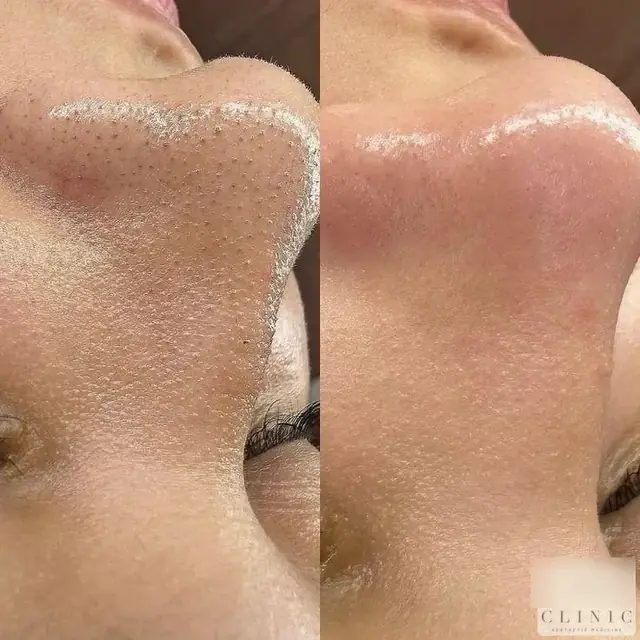Hydrofacial2