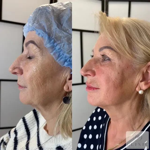 Chemicky peeling2