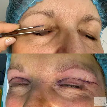 Operácia viečok – blefaroplastika – referencia 5