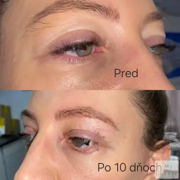 Operácia viečok – blefaroplastika – referencia 27