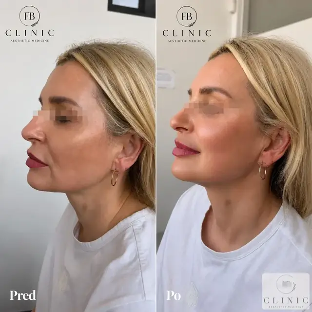 Ultherapy®