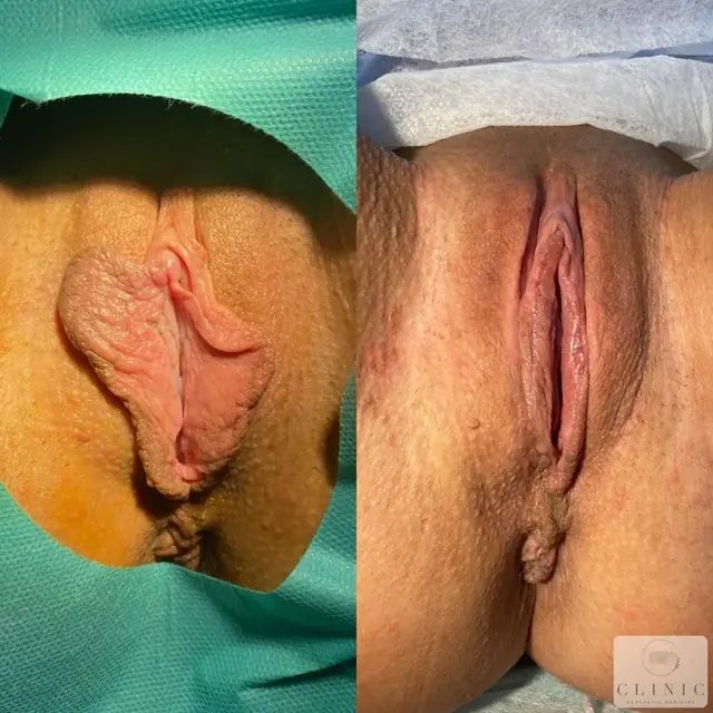 Estetická gynekológia – referencia 7