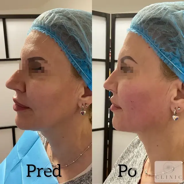 Endolift