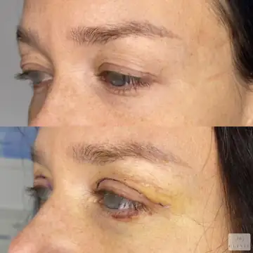 Operácia viečok – blefaroplastika – referencia 9