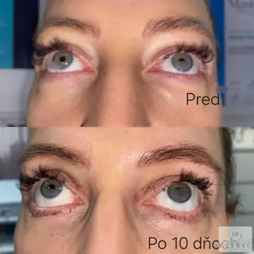 Operácia viečok – blefaroplastika – referencia 26