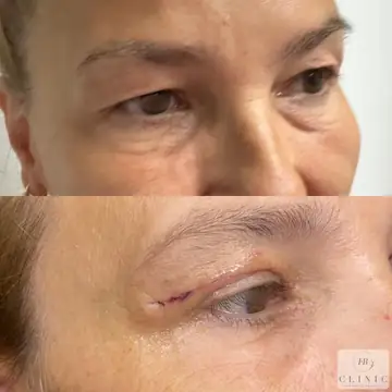 Operácia viečok – blefaroplastika – referencia 17