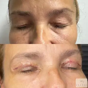 Operácia viečok – blefaroplastika – referencia 19