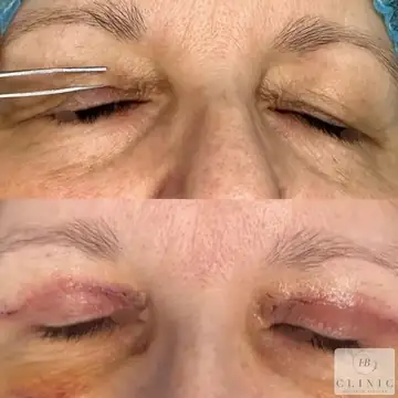 Operácia viečok – blefaroplastika – referencia 15