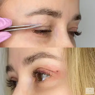 Operácia viečok – blefaroplastika – referencia 1