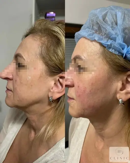 Endolift5