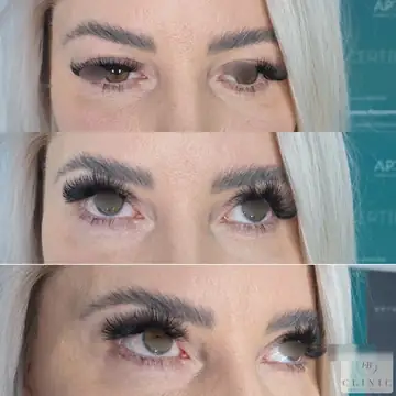 Operácia viečok – blefaroplastika – referencia 8