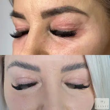 Operácia viečok – blefaroplastika – referencia 7