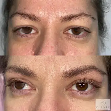 Operácia viečok – blefaroplastika – referencia 24
