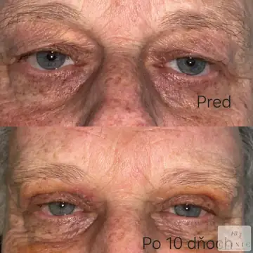Operácia viečok – blefaroplastika – referencia 22