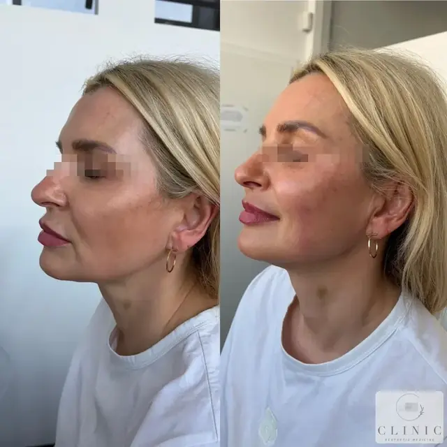 Ultherapy 4