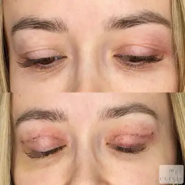Operácia viečok – blefaroplastika – referencia 4