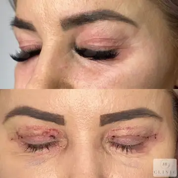 Operácia viečok – blefaroplastika – referencia 2