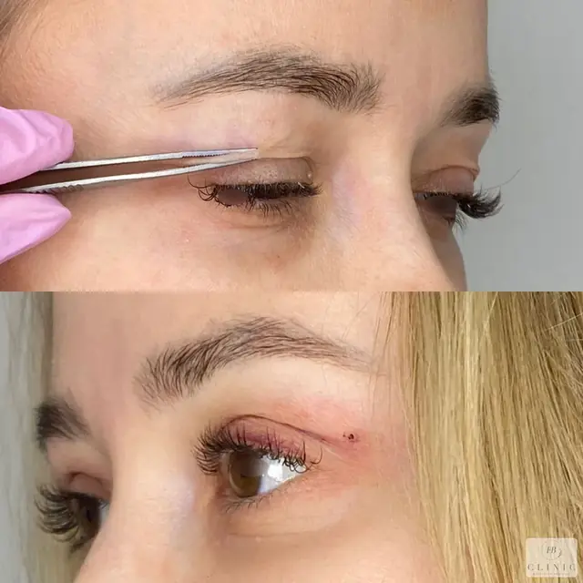 Operácia viečok – blefaroplastika