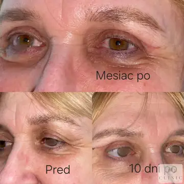 Operácia viečok – blefaroplastika – referencia 23