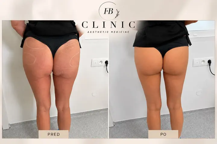 Body Filler – výsledok FB Clinic pred a po