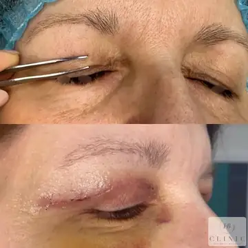 Operácia viečok – blefaroplastika – referencia 14