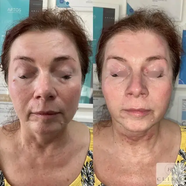 Skinbooster