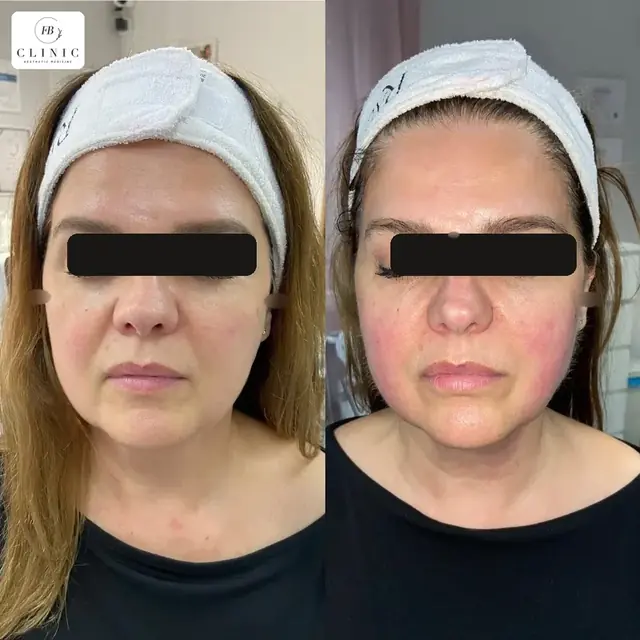 Ultherapy® – referencia 3