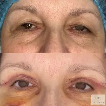 Operácia viečok – blefaroplastika – referencia 12