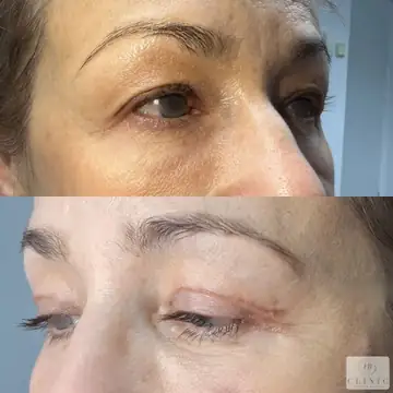 Operácia viečok – blefaroplastika – referencia 6