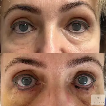 Operácia viečok – blefaroplastika – referencia 16
