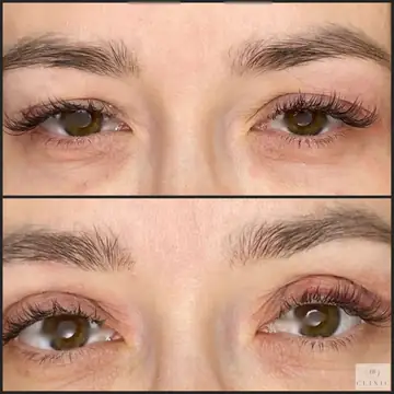 Operácia viečok – blefaroplastika – referencia 3